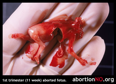 fetus at 11 weeks